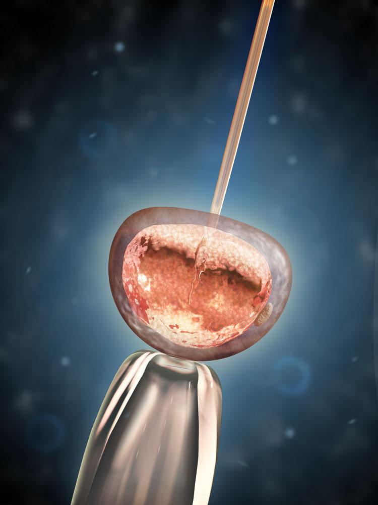 试管婴儿的费用分析